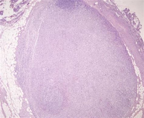 H&E 4x, cervical lymph node biopsy section showing a large necrotic ...