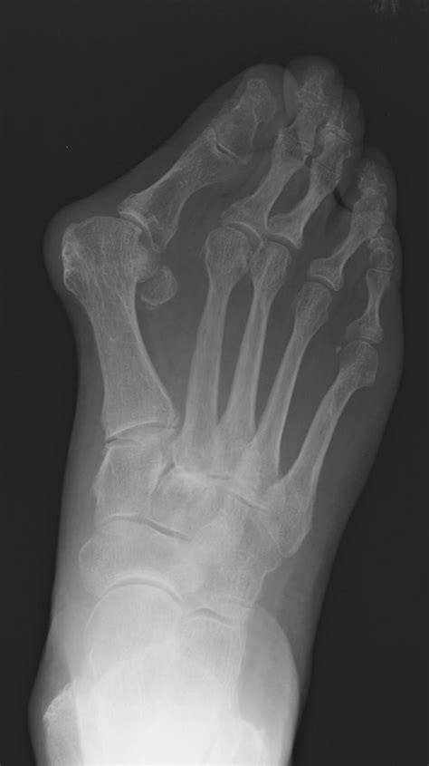 Hallux valgus - Radiology at St. Vincent's University Hospital