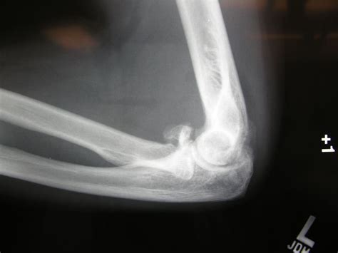 radial head fracture | Elbow, Hands, Wrist