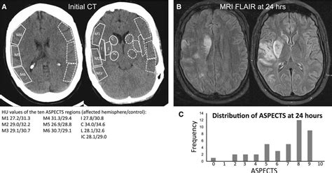 Aspects Alberta Stroke Program Early Ct Score Measurement Using