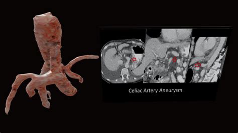 Celiac Artery Aneurysm - Download Free 3D model by tl0615 [1723482 ...