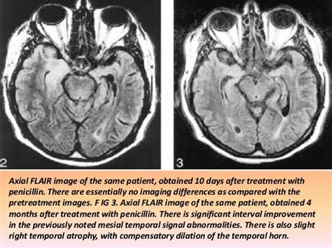 Presentation1pptx Radiological Imaging Of Syphilis