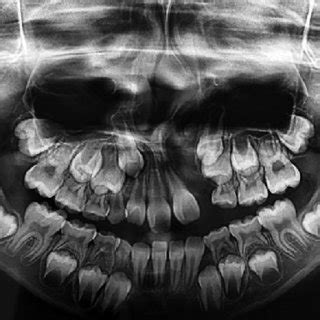 Panoramic Radiograph Showing Agenesis Of The Left Lateral Incisor