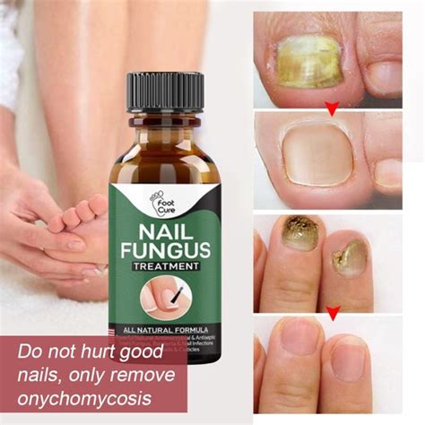 Nail Fungus Treatment Best Nail Repair Stop Fungal Growth Effective