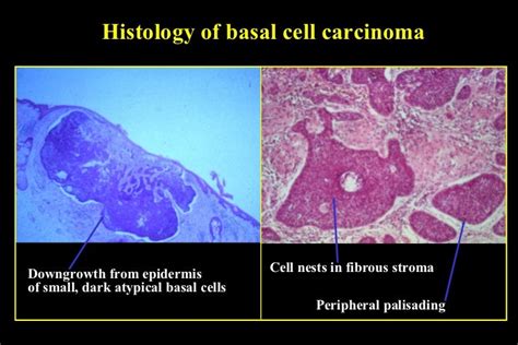 05 Malignant Eyelid Tumours