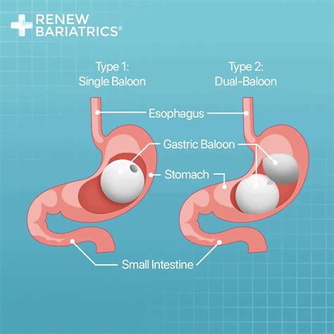 Gastric Balloon In Mexico From 3699 Usd Renew Bariatrics