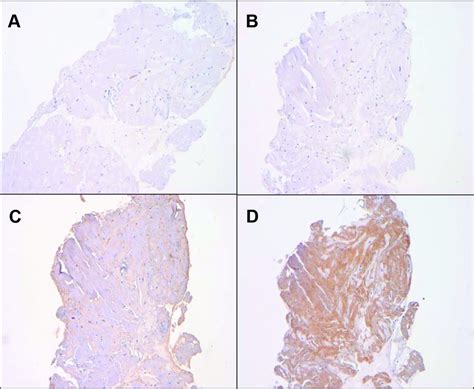 Transthyretin Ttr Cardiac Amyloidosis Circulation