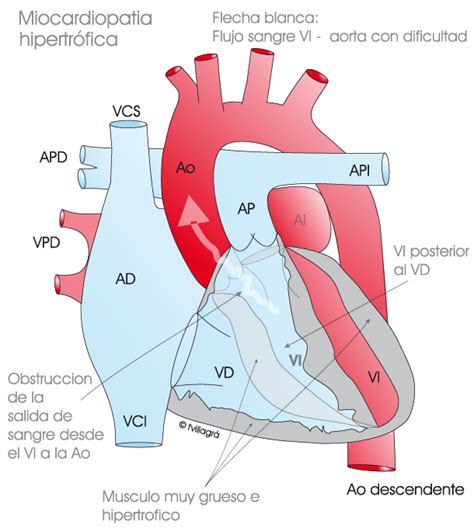 Miocardiopatía Hipertrófica Mch La Web De Las Cardiopatías Congénitas