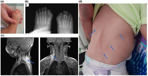 Clinical Features Of The Proband Ab Bilateral Malformation Of The