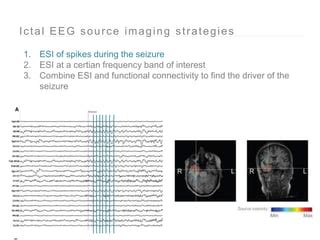 Ictal Eeg Source Imaging Ppt