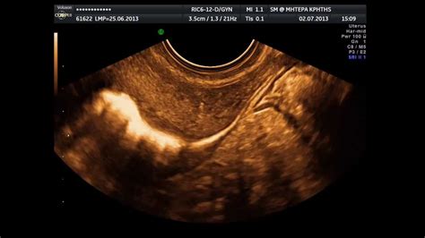 Hysterosalpingo Contrast Sonography Hycosy Normal Study Youtube