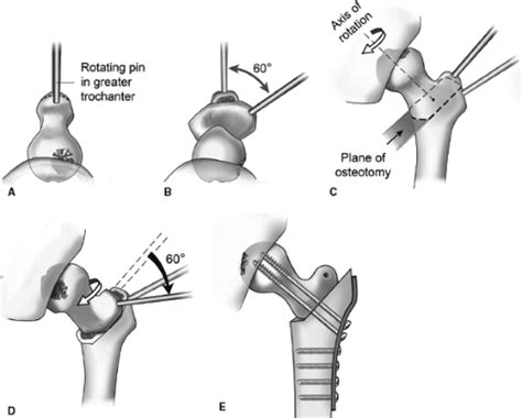 Proximal Femoral Osteotomy