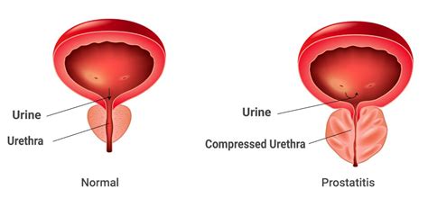 Prostatitis: Explained Symptoms, Causes, & Treatment Guide