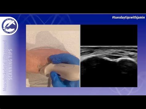 How To Locate The Lisfranc Ligament Of The Foot On Ultrasound YouTube