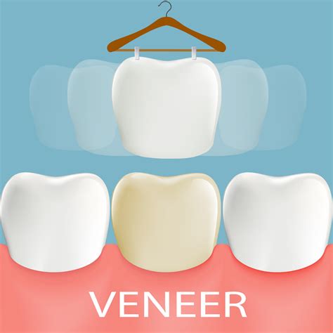 How Do Veneers Work How The Smile Makeover Takes Place