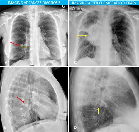 A Challenging Case Of Radiation Induced Lung Fibrosis The American