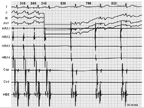 Figure 1 From Transient Atrioventricular Block Following Catheter