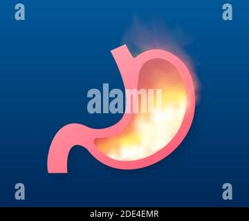 Stomach Acidity Illustration Stock Photo Alamy