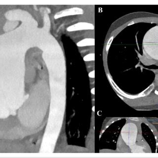 Computed Tomography Angiography Demonstrating Severe Ascending Aortic