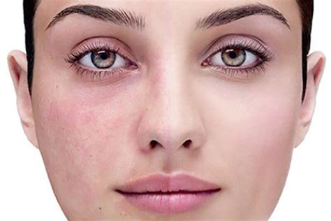 Natural Rosacea Treatments That Actually Work