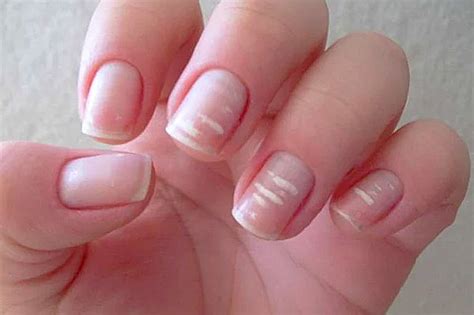 Как избавиться от белых пятен на ногтях - Гармония ЖизниГармония Жизни