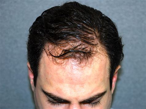hair transplant clinic toronto hair restoration surgery