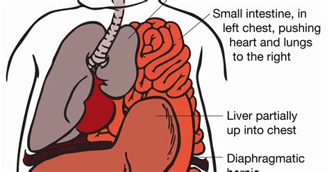 What Is A Diaphragmatic Hernia In Adults - erogonchina