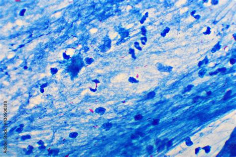 Mycobacterium Tuberculosis Positive Small Red Rod In Sputum Smear Acid Fast Stain Analyze By