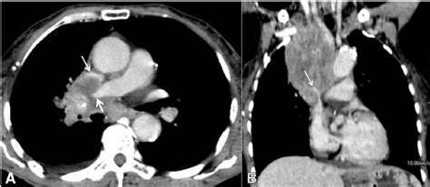 A 55 Year Old Man With Superior Vena Cava Syndrome Computed