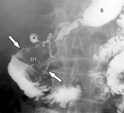 Fluoroscopic Evaluation Of Duodenal Diseases Radiographics