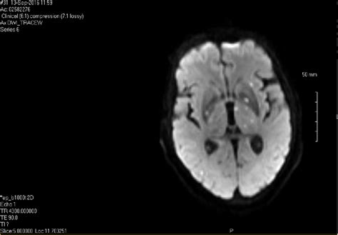 Axial View Of Mri Brain Showing Multiple Small Embolic Infarcts Dwi