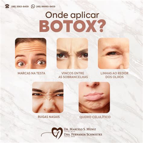 Onde Aplicar Botox Odonto Muniz