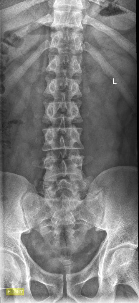 Lumbarization Of S1 Vertebra Radiology Case