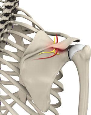 Suprascapular Nerve Decompression Cincinnati Minimally Invasive