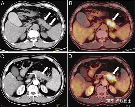 Petct胰腺癌检查诊断 知乎