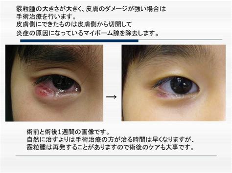 霰粒腫 カネモリ眼科形成外科クリニック