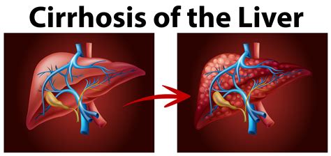 Diagram Showing Cirrhosis Of The Liver Vector Art At Vecteezy