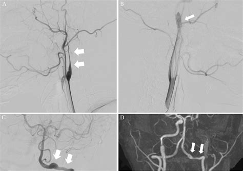 Figure 1 From Bilateral Internal Carotid And Left Vertebral Artery