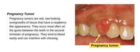 Pregnancy Gingivitis Treat Swollen Gums During Pregnancy