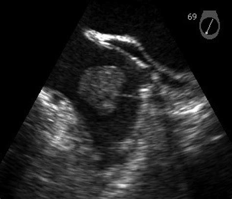 A Left Atrial Appendage Thrombus Mimicking Atrial Myxoma Circulation