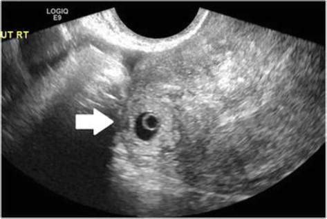 Non Tubal Ectopic Pregnancy Incidence And Diagnosis Intechopen