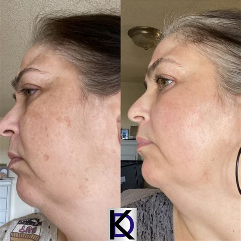 Cosmelan At Home Peel Kit Beauty By Dr Kay