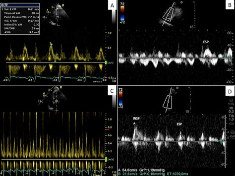 Pericarditis constrictiva en paciente postrasplante cardíaco