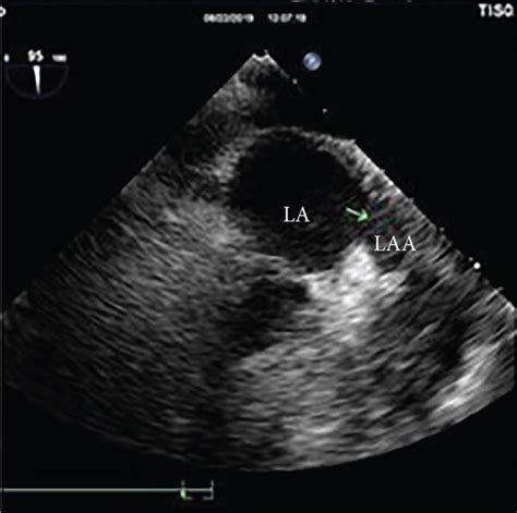 Transesophageal Echocardiography Tee Images Before The Operation Download Scientific Diagram