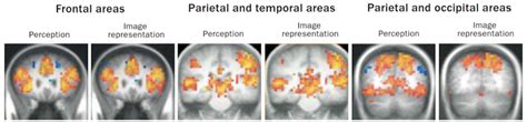 What Is Aphantasia Aphantasia Cure Symptoms Treatments