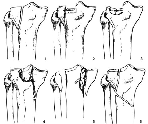 Tibial Plateau Fractures Core Em