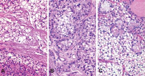 Clear Cell Carcinoma Review Of Its Histomorphogenesis And