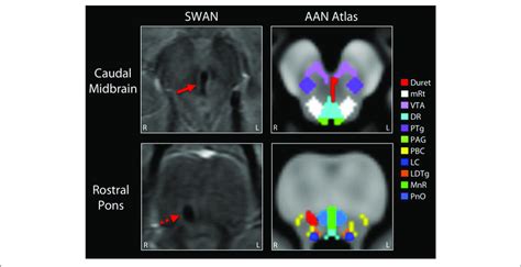 | Mapping the Duret hemorrhage lesions to the ascending arousal network ...