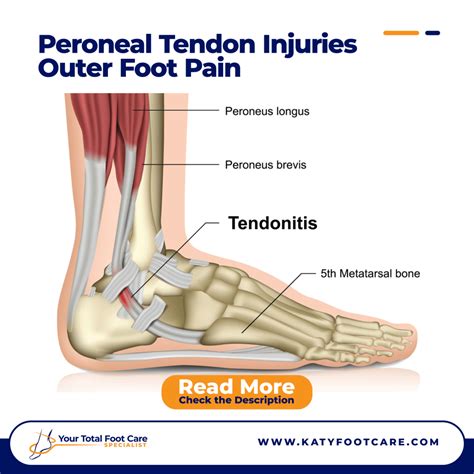 Peroneal Tendon Injuries – Outer Foot Pain | Katy Foot Care