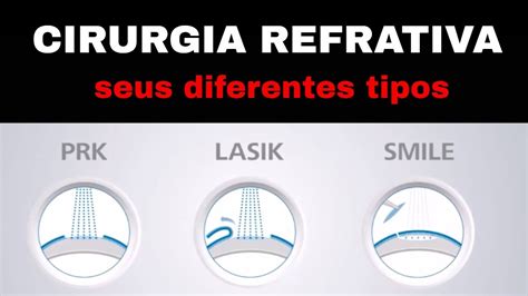 Diferen A Entre As Cirurgias Refrativas A Laser Prk Lasik E Smile